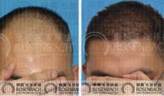 四级脱发发友在广州乐鬓植发中心植发一年后的效果