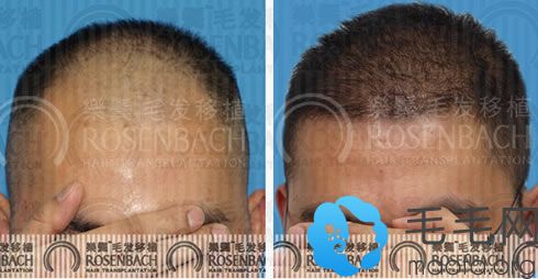 广州乐鬓植发中心植发前后效果图