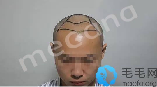 小胡种植发际线和头顶加密手术方案