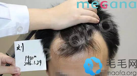 刘先生在植发手术前的额角照片