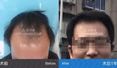 M型脱发2年之久的王先生选择碧莲盛植发1年的效果分享