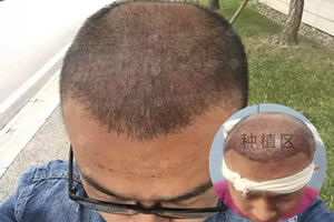 26岁程序猿小哥分享在四川华美紫馨植发1个月的恢复效果图