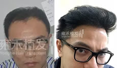 仇先生分享在杭州雍禾植发3636毛囊8个月恢复过程及效果