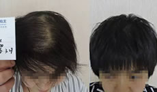 看严重脱发的王女士在太原雍禾植发六个月恢复效果怎么样