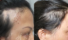 疤痕上能植发吗 刘女士在广州新发现疤痕植发6个月恢复效果