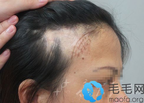 广州新发现植发疤痕植发术前设计