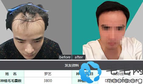 青逸种植头发术后对比图