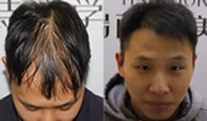 植发真实案例告诉你南京植发效果怎么样？
