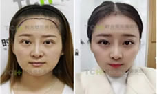 “女汉子”在杭州时光植发中心植发际线摇身变网红历程