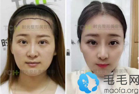 杭州时光毛发移植中心女性植发际线效果图