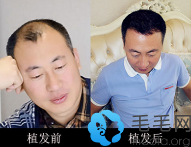在北京博士园毛发研究中心植发前后效果对比图