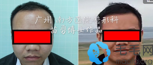 广州南方医院整形科苗勇博士植发案例前后对比图