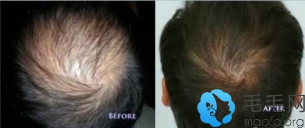 脂溢性脱发植发后半年恢复效果
