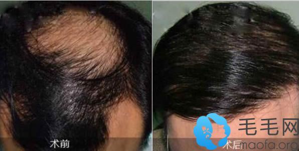雄性激素脱发通过种植头发后的效果