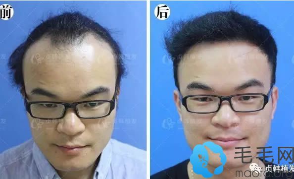 毛发移植一年后恢复效果对比图