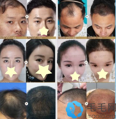 毛发移植案例恢复效果前后对比