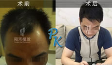 图片记录脂溢性脱发在北京雍禾植发际线10个月恢复效果