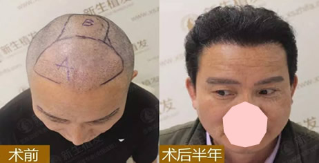 求鉴定：用广州新生的TDDP种植3000毛囊单位植发+植眉后效果