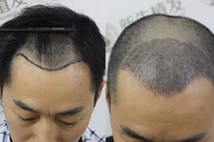 我去年在上海新生植发3000单位毛囊，6个月恢复效果很满意