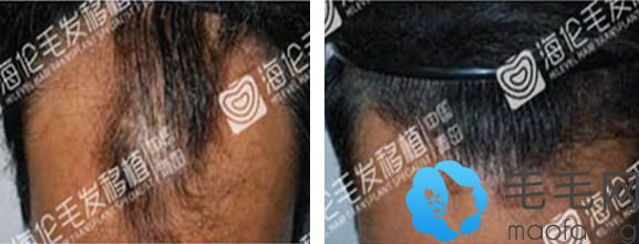 脂溢性脱发在青岛海伦植发一年效果