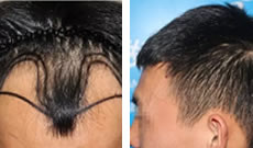 晒几张我在北京雍禾植发际线和头发加密10个月后的图片