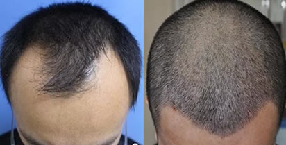 雄性激素脱发能治好吗？看北京中山医院植发2000毛囊的效果