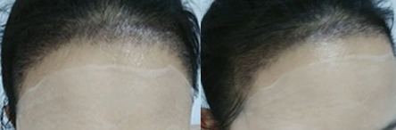 毛发移植医生吴文育做发际线种植术后第14天效果图