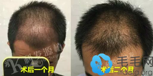 沈阳科发源植发毛发移植术后一个月和二个月效果图