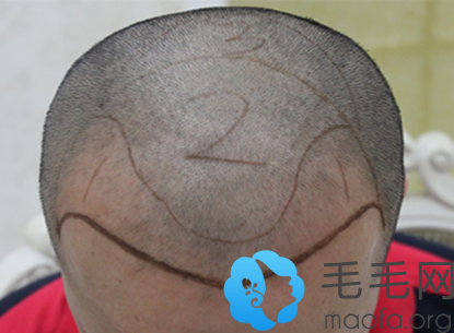 去深圳科发源植发种植头发术前设计照