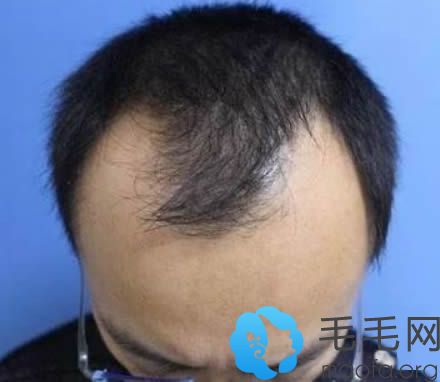 我在北京八大处种植头发术前照