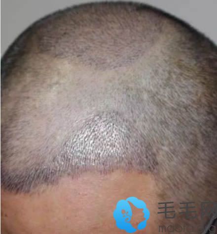 在北京八大处植发后第7天的样子