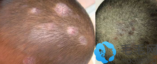 值得关注：头皮脂溢性皮炎会引起脱发吗？该怎么治疗呢？