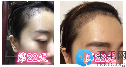 女生在深圳流花医院种植2000单位植发际线案例术后第22天-第28天脱落期样子