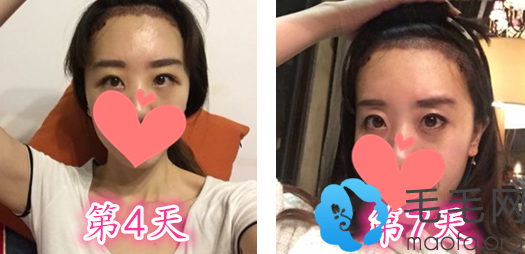 找深圳流花医院种植发际线术后第4-7天恢复过程图片