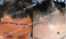 在杭州维多利亚花29500元做了植发手术,半个月就看到了效果