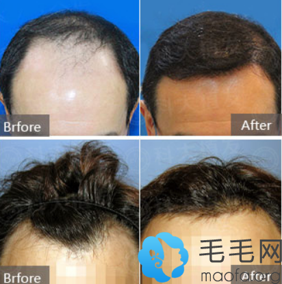 在重庆东方植发找王德虎做头发种植案例+发际线种植案例前后对比图：