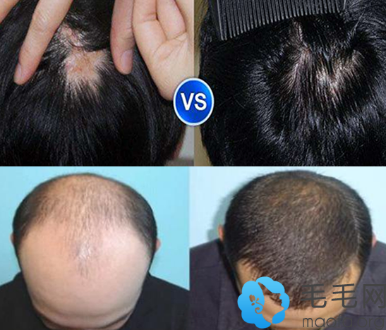 北京协和医院植发怎么样？看头发案例+疤痕种植案例效果展示