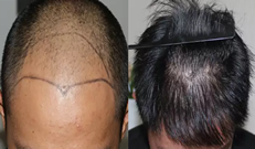 在北京协和医院植发已经5年了 给大家看看我的头发怎么样了