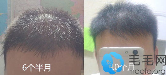 郑州华山医院头发移植术后第6个半月和10个月效果图一览