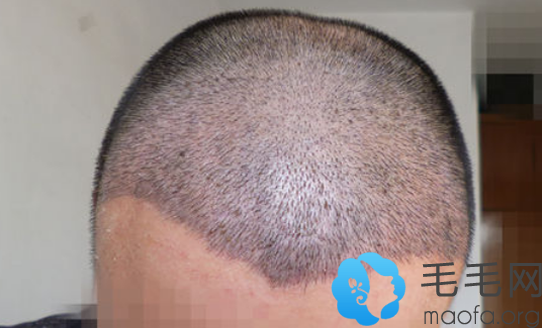在郑州华山医院做头发种植术后第9天恢复情况