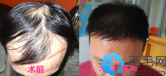 大面积脱发男士在郑州华山医院做发际线种植+头顶加密案例前后效果对比图