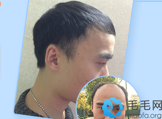 大面积秃顶男士在上海华山医院做发际线种植+头顶加密种植案例前后效果对比图