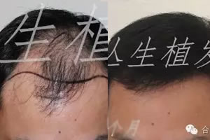 合肥丛生植发际线案例:王老板花4.6万植发后额角长出了头发