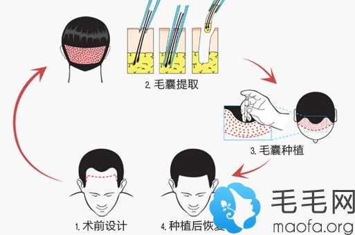 植发手术过程图示