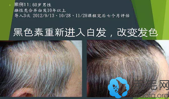 北京博士园治疗白发靠谱吗？看真人白发专黑发效果图验证