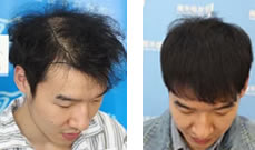 看看我这个脱发的年轻人来郑州雍禾种植的头发效果怎么样