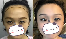 晒我在广州新生做发际线+眉毛种植恢复过程照片