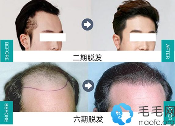 二级脱发头发种植案例+六级脱发植发案例