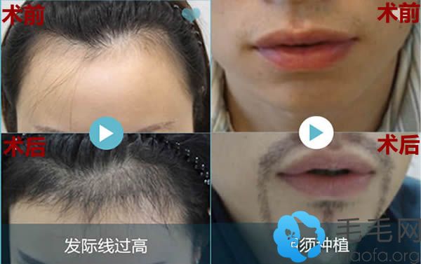重庆华美植发和种植胡须案例效果图