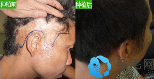 昆明育森植发中心王斌疤痕种植头发案例